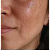 tratamento de melasma na pele Sítios Frutal