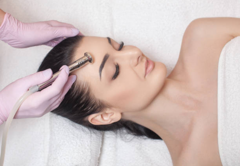 Tratamento de Peeling de Diamante para Acne Vila DAgostinho - Peeling de Diamante Facial Campinas
